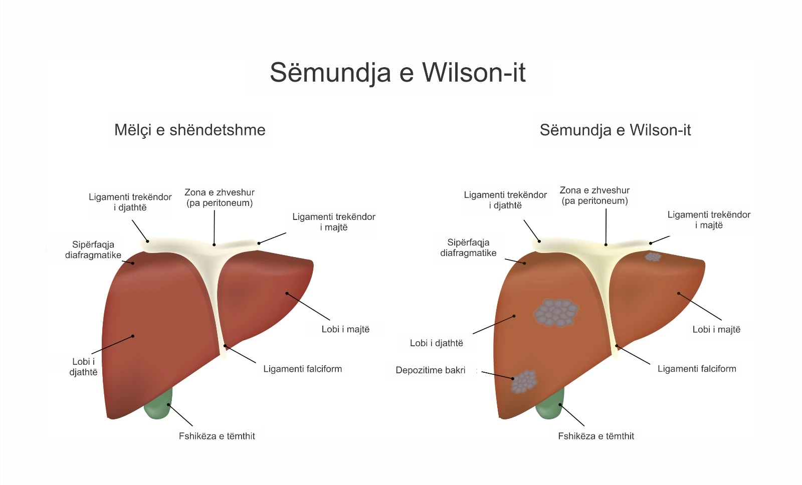 Diagram që krahason mëlçinë e shëndetshme me mëlçinë e prekur nga Sëmundja e Wilson-it me depozitime bakri.
